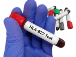 HLA-B27 FLOW CYTOMETRY