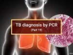 MYCOBACTERIUM TUBERCULOSIS PCR; MYCOSURE; TB PCR