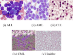 ACUTE LEUKEMIA DIAGNOSTIC COMPREHENSIVE PROFILE